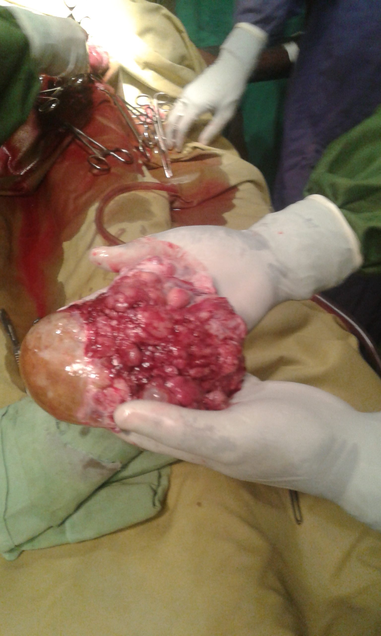 ovary and uterus cancer